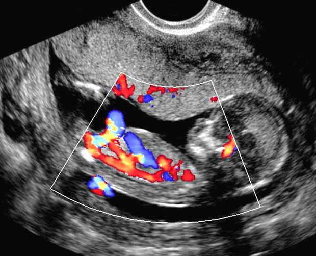 A importÃ¢ncia da ultrassonografia morfolÃ³gica fetal no1Âº trimestre .