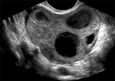 Aspectos EcogrÃ¡ficos da Endometriose