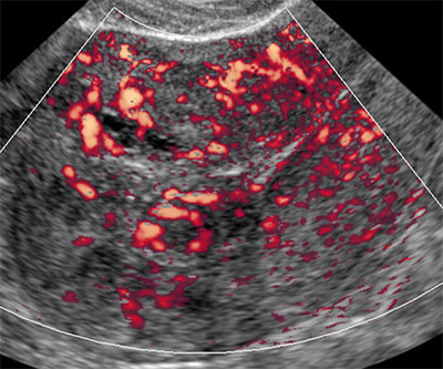 DiagnÃ³stico EcogrÃ¡fico da Adenomiose