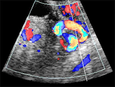 Doppler na Esterilidade Feminina