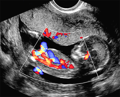 Doppler no Primeiro Trimestre da GestaÃ§Ã£o
