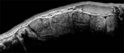 Ultrassonografia das HÃ©rnias Intestinais