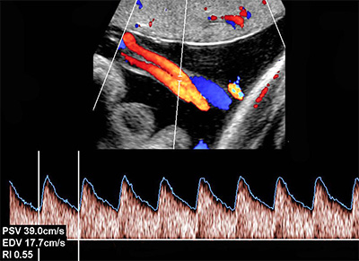 Ultrassonografia no Sofrimento Fetal CrÃ´nico